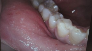 口腔内の小水疱 若葉駅前歯科
