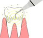 歯周治療のリスク