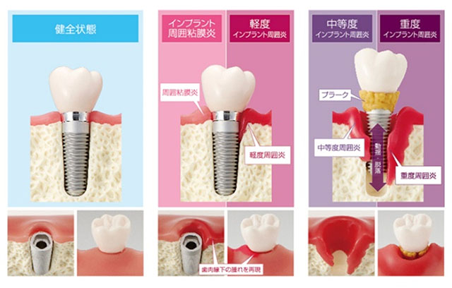 インプラント周囲粘膜炎・インプラント周囲炎