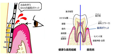 歯周外科