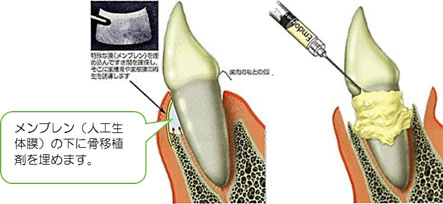 歯周組織再生法