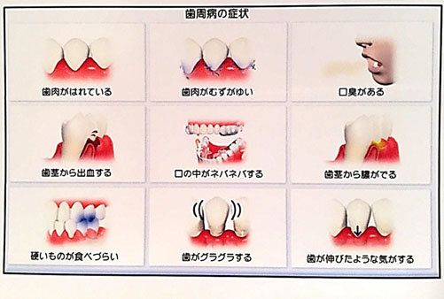 歯周病の症状