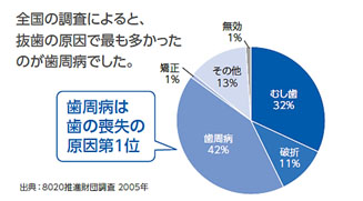 歯周病は歯の喪失の原因第1位