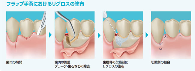 フラップ手術におけるリグロスの塗布