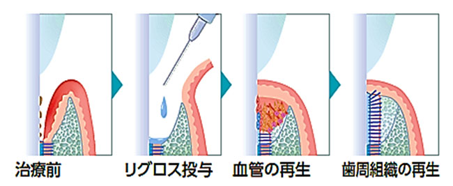 歯周組織の再生