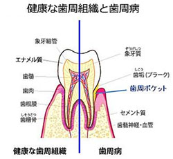 健康な歯周組織と歯周病