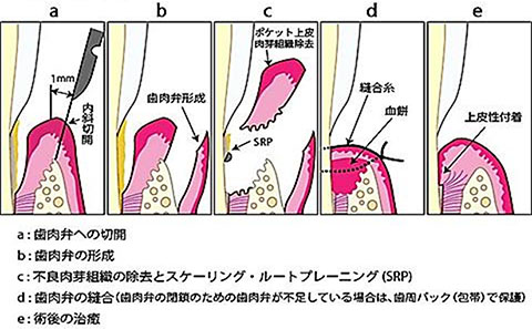 フラップ手術の流れ