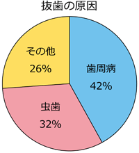 抜歯の原因